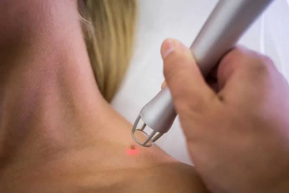 Kaszak pod skórą – dlaczego powstaje i kiedy warto zdecydować się na jego usunięcie?